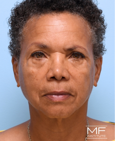 Woman before Filler for Under Eye Wrinkles treatment.