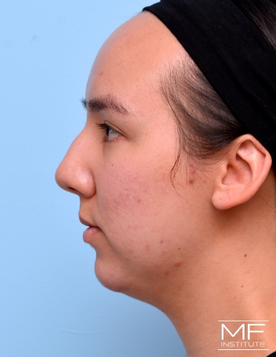 After 2 of 3 treatments for Chin Filler for Double Chin