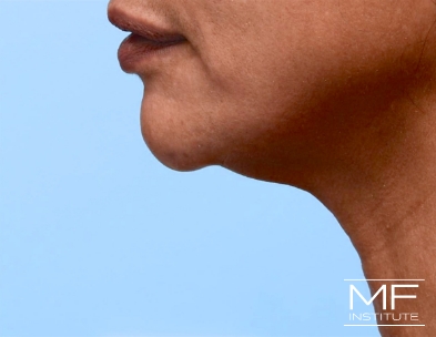 After 2 of 3 treatments for Chin Filler and KYBELLA for Double Chin