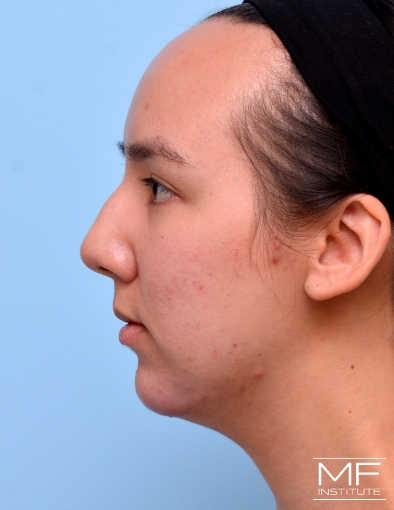 After 3 of 3 treatments for Chin Filler for Double Chin