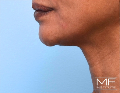 After 3 of 3 treatments for Chin Filler and KYBELLA for Double Chin