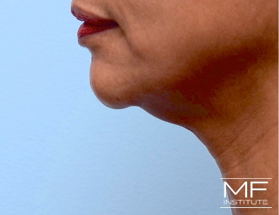 Before Chin Filler and KYBELLA for Double Chin