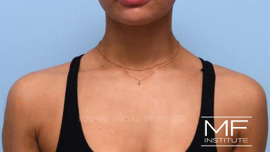 After Trapezius BOTOX