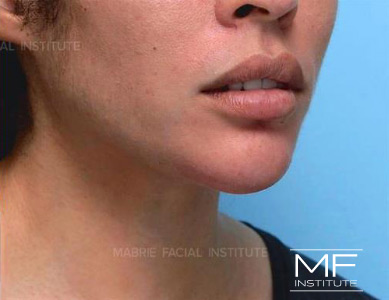 After Chin Augmentation with Filler & Mentalis BOTOX