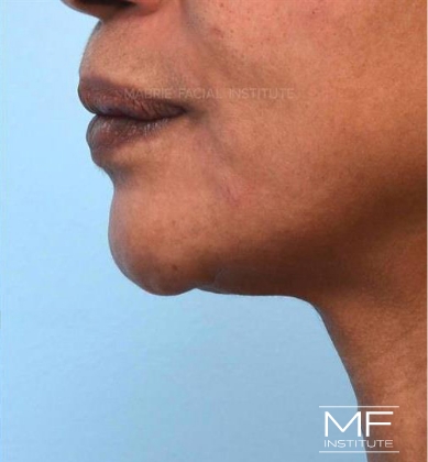 After Double Chin Treatment With KYBELLA