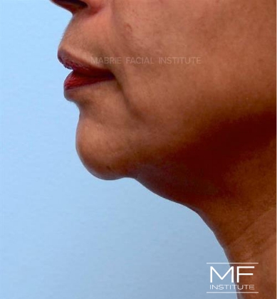 Before Double Chin Treatment With KYBELLA