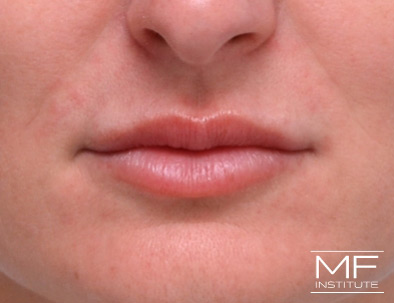 Close up of a woman's lips, two months after treatment.