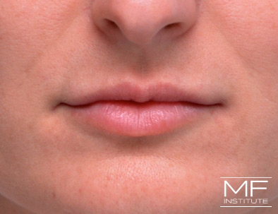 Close up of a woman's lips, after receiving the second of two Lip Filler treatments.