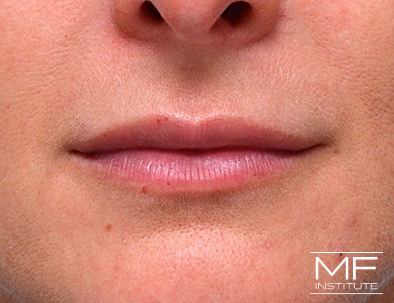 Close up of a woman's lips, two months after treatment.