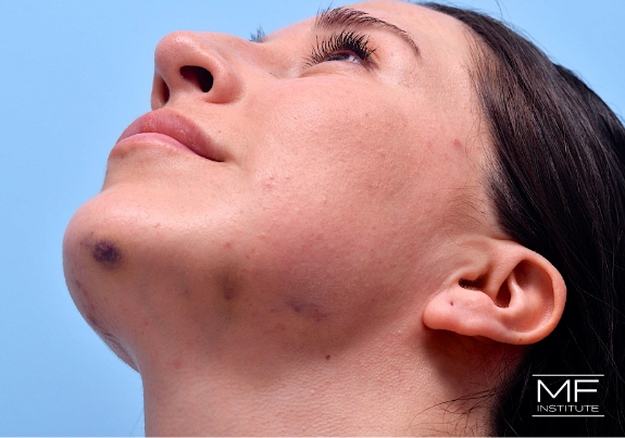 Recovery images after jawline contouring