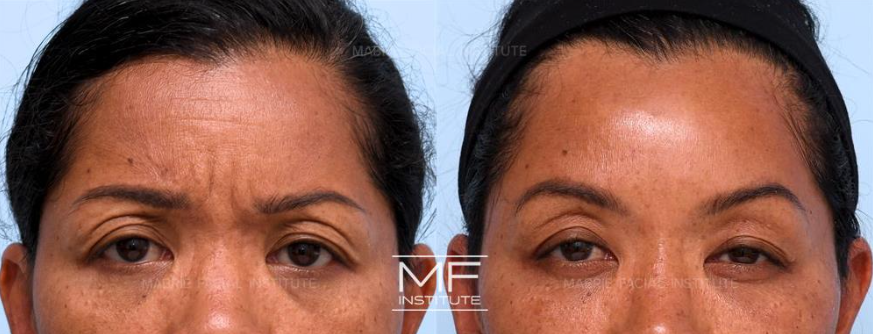 Before and After BOTOX for Forehead/Glabella Wrinkles case #751