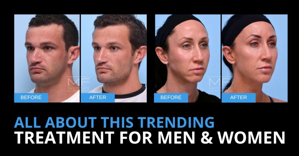 Real patient before and after jawline filler results and text that reads 'All About This Trending Treatment For Men & Women'