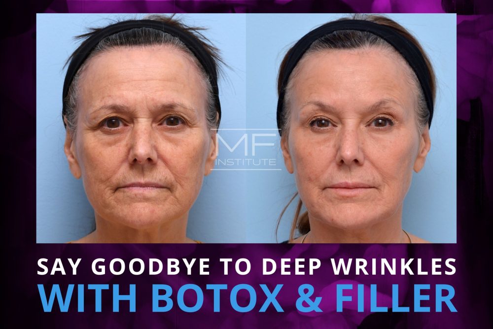 Before and after case #1182 with text that reads 'Say Goodbye To Deep Wrinkles With BOTOX & Filler'