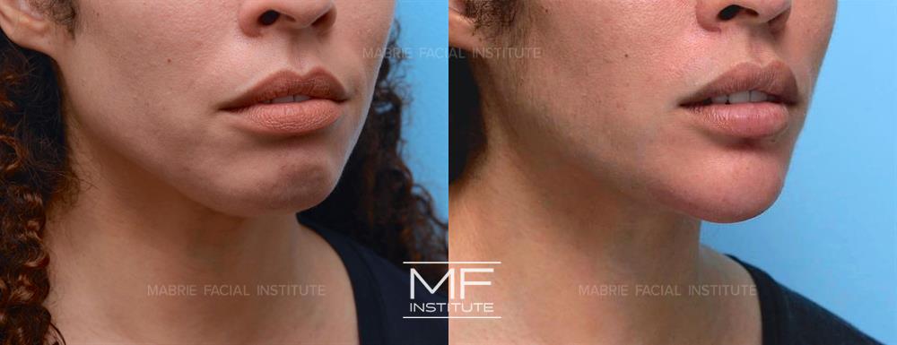 Before and after BOTOX and filler for chin augmentation case #425