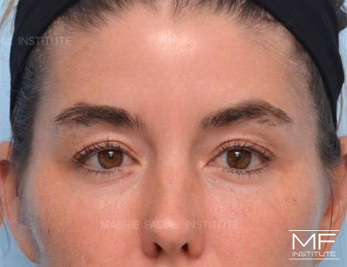 Woman after receiving upper face botox treatment