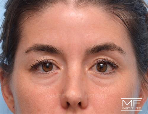 Woman before receiving upper face botox treatment