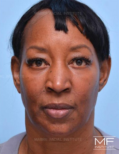 Woman after treatment combining Fillers and BOTOX for Nasolabial Folds