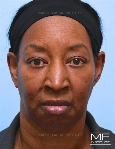 Woman before treatment combining Fillers and BOTOX for Nasolabial Folds