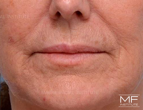 Woman after Lip Filler and BOTOX treatment for Vertical Lines Around the Mouth