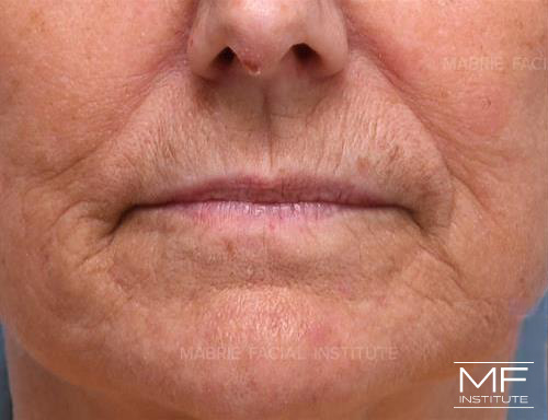 Woman before Lip Filler and BOTOX treatment for Vertical Lines Around the Mouth