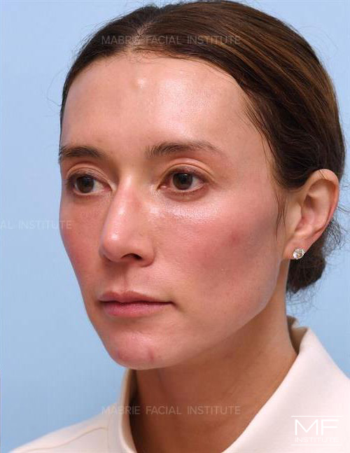 Woman after Sculptra temple filler treatment