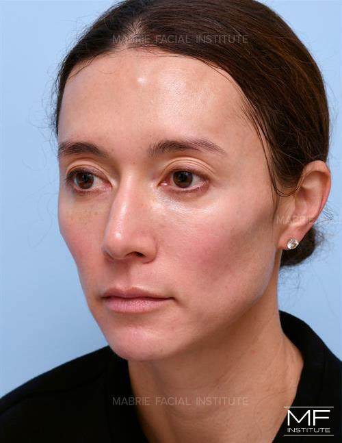 Woman before Sculptra temple filler treatment