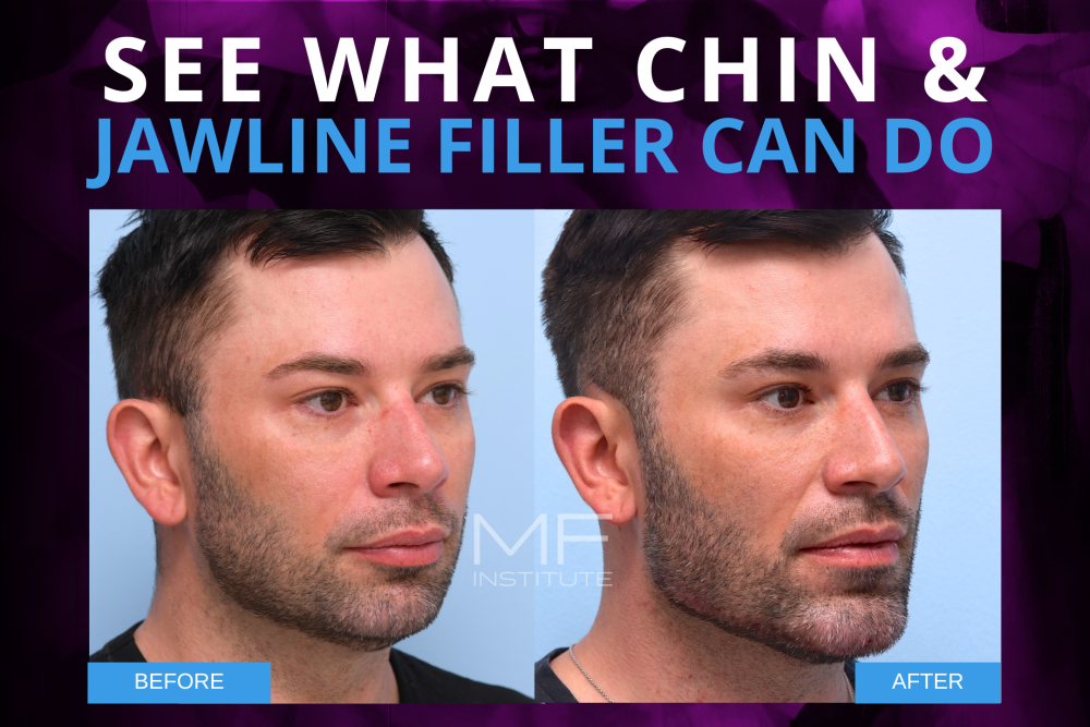 See What Chin & Jawline Filler Can Do