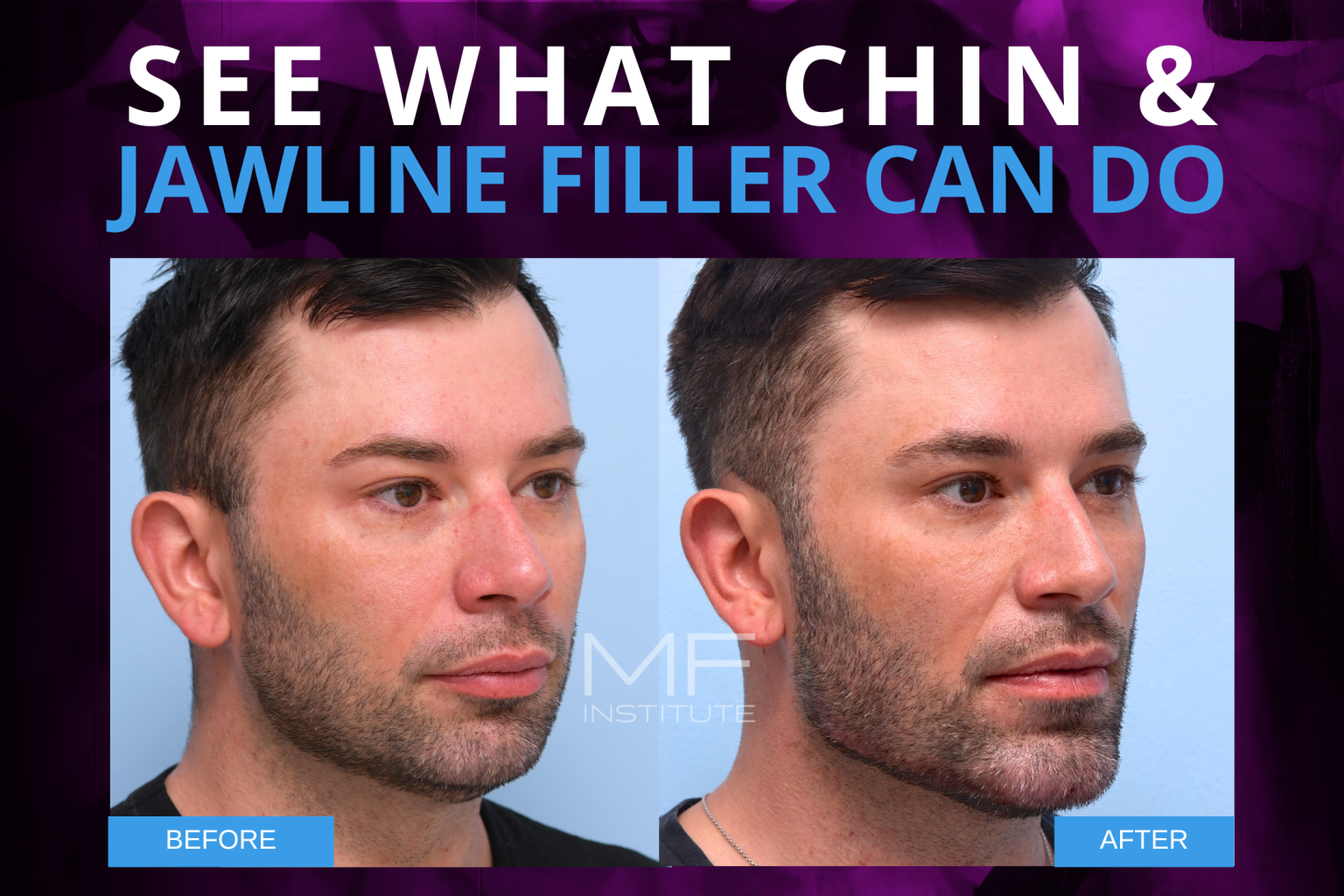 Chin And Jawline Filler A Before And After Showcase Of Whats Possible Mabrie Facial Institute 