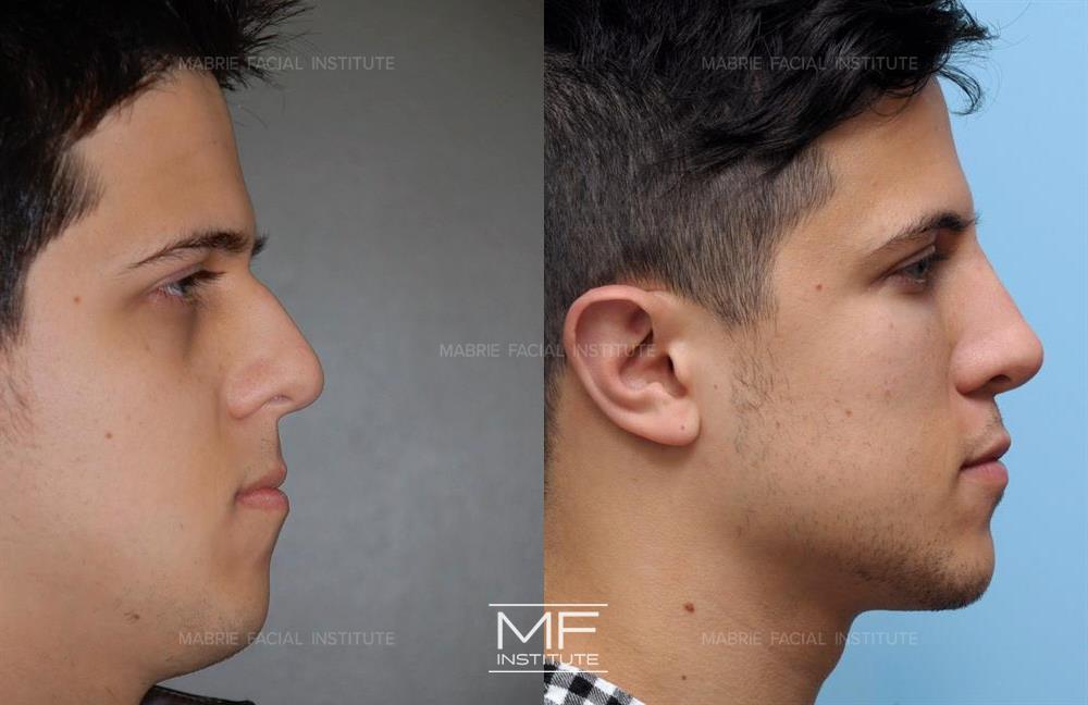 Before and after jawline filler to improve the appearance of the neck case #1090