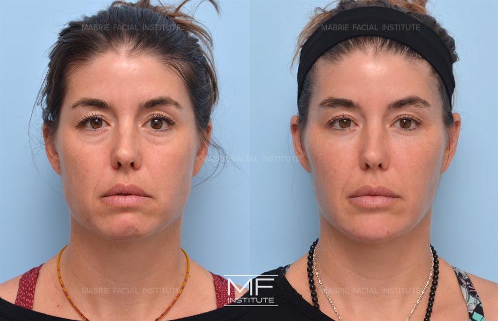 Before and after chin filler to improve facial symmetry case #1167