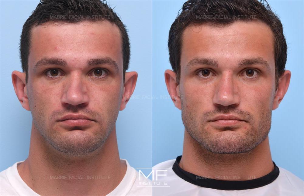 Before and after chin filler to make the chin wider or more square case #1193