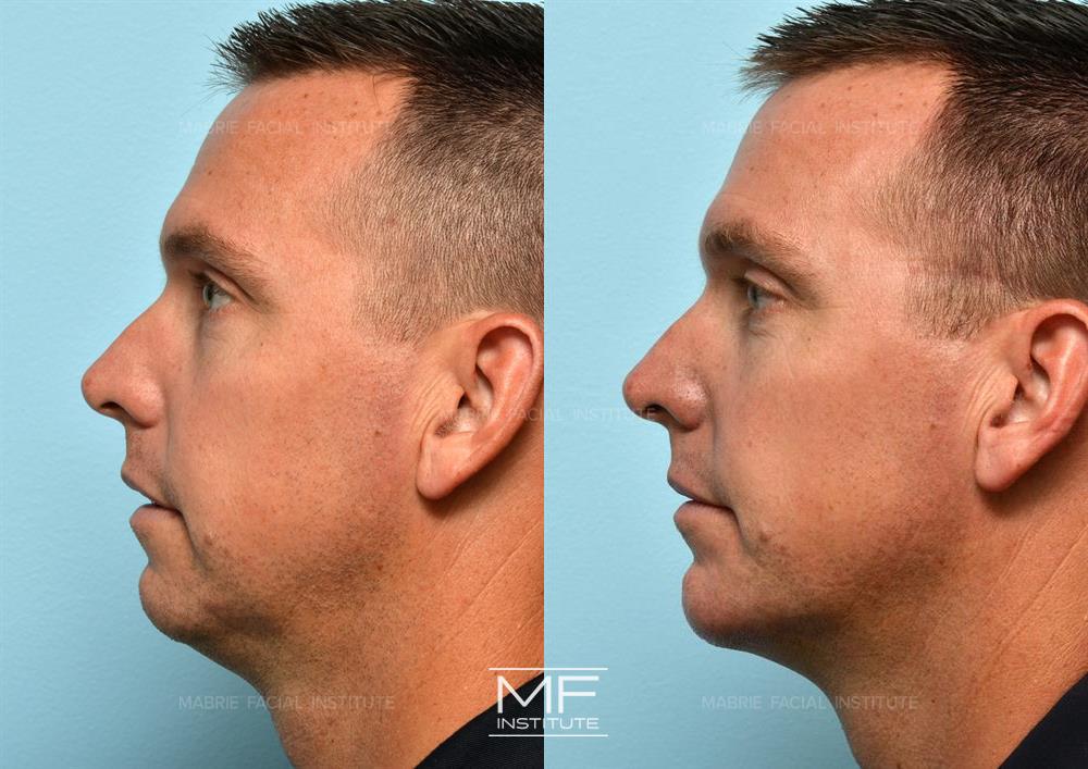 Before and after jawline filler to reduce jowling case #335