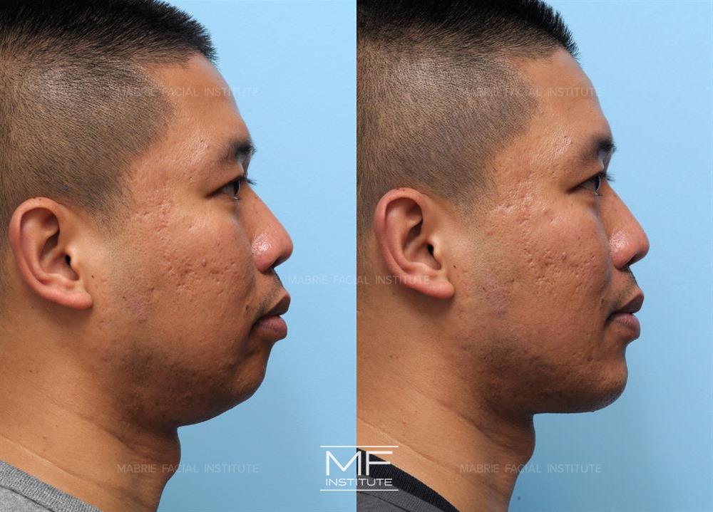 Before and after jawline filler to improve the appearance of the neck case #339