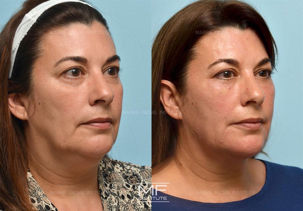 Before and after jawline filler to reduce jowling case #402