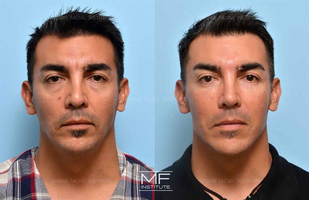 Before and after jawline filler to increase mandibular angles case #404