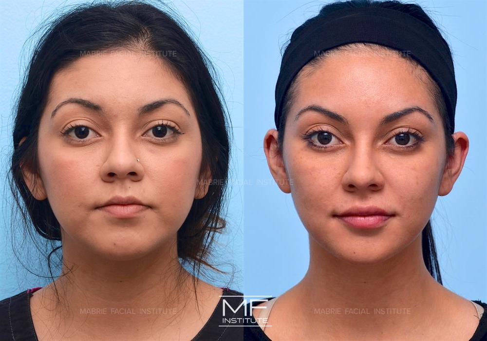 Before and after chin filler for a V-shaped face case #415