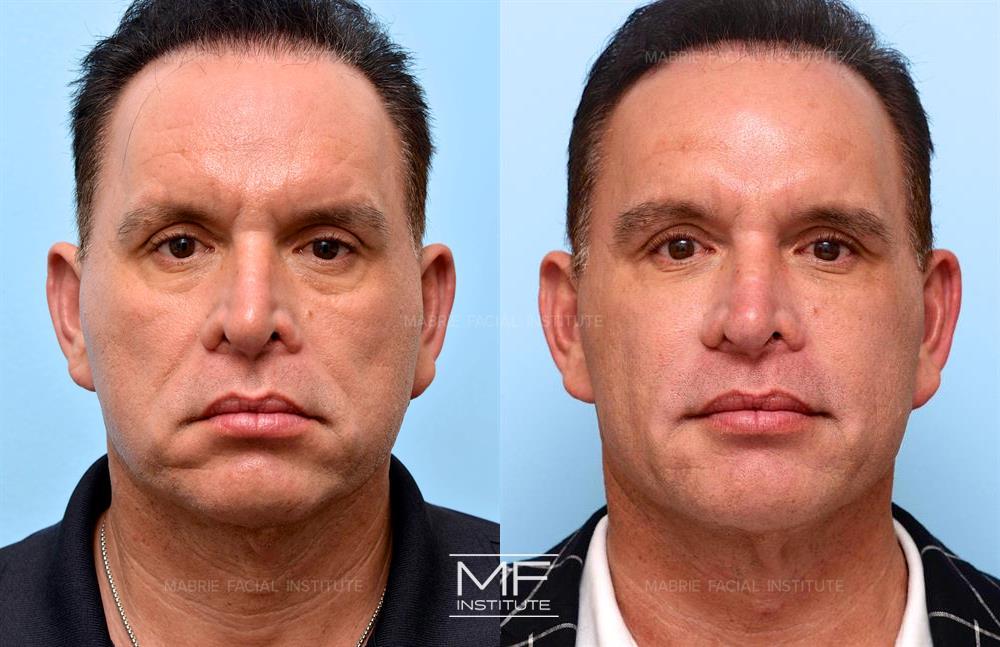 Before and after jawline filler to make you look younger case #433