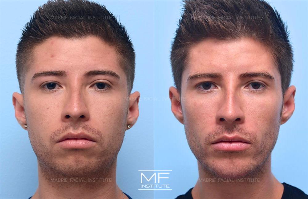 Before and after chin filler to balance facial proportions case #496