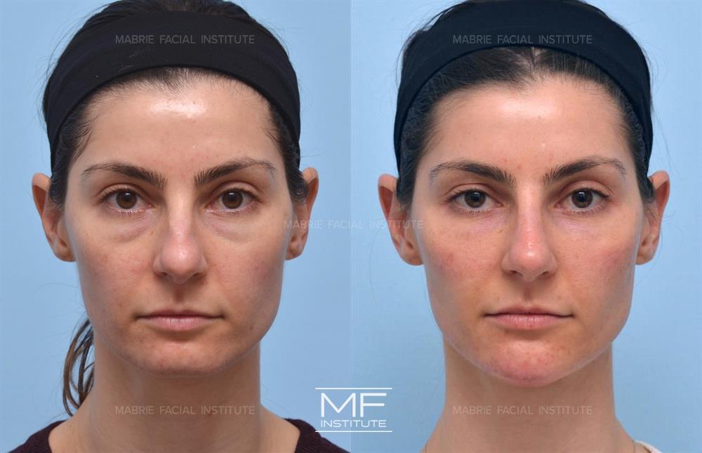 Before and after chin filler for a V-shaped face case #519