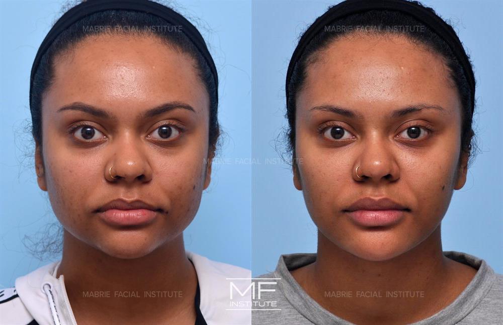 Before and after chin filler to balance facial proportions case #572