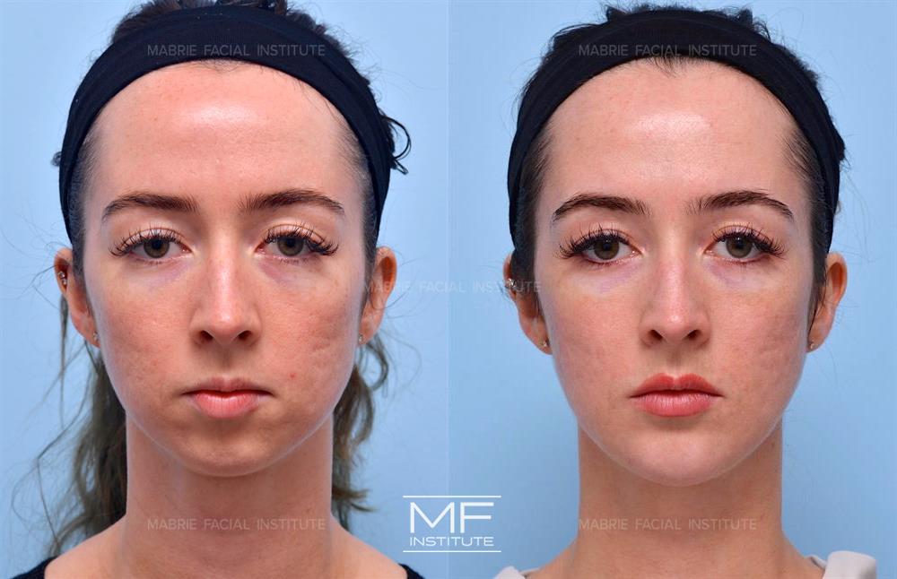 Before and after chin filler to balance facial proportions case #582