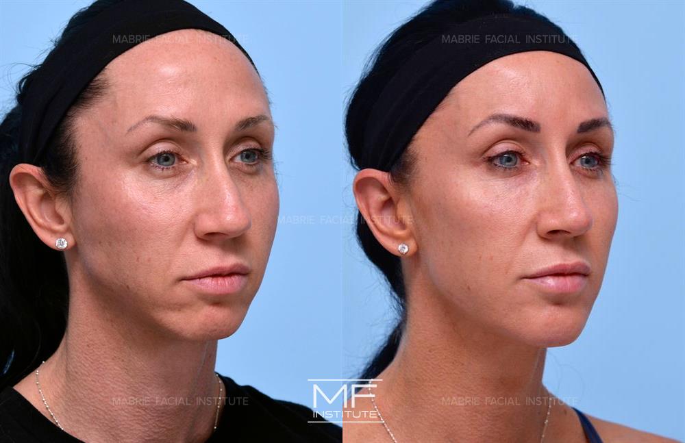 Before and after jawline filler to snatch your face case #624