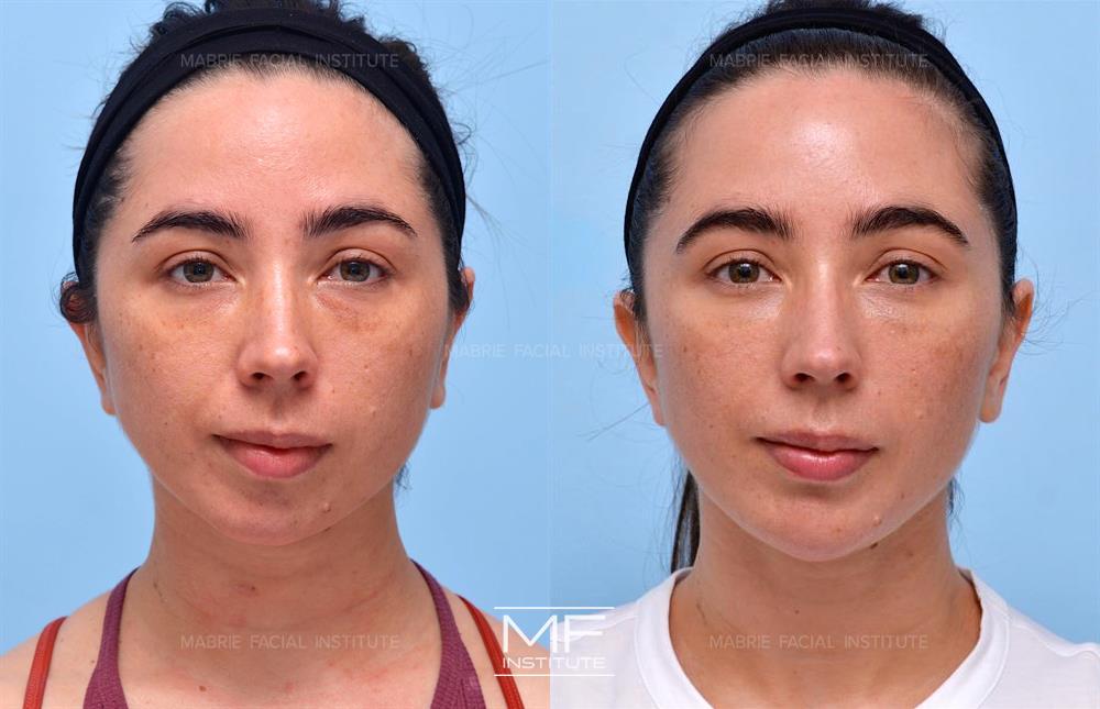 Before and after chin filler to improve facial symmetry case #644