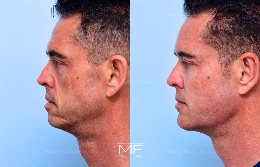 Before and after jawline filler to snatch your face case #645