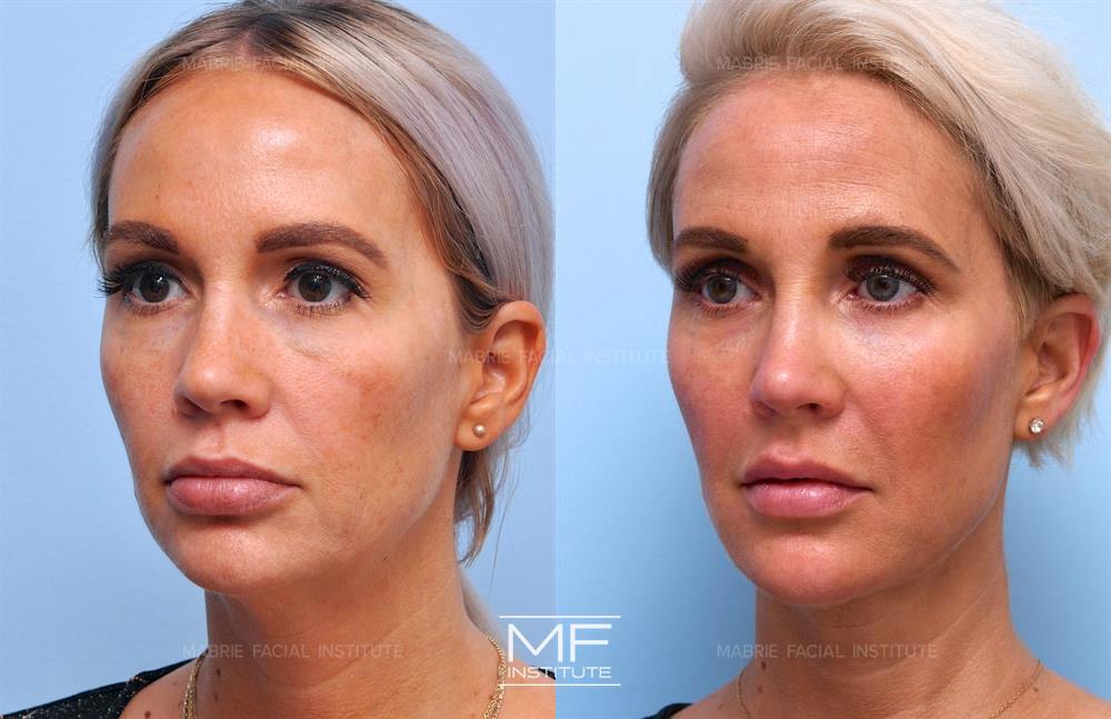 Before and after jawline filler to make you look younger case #681