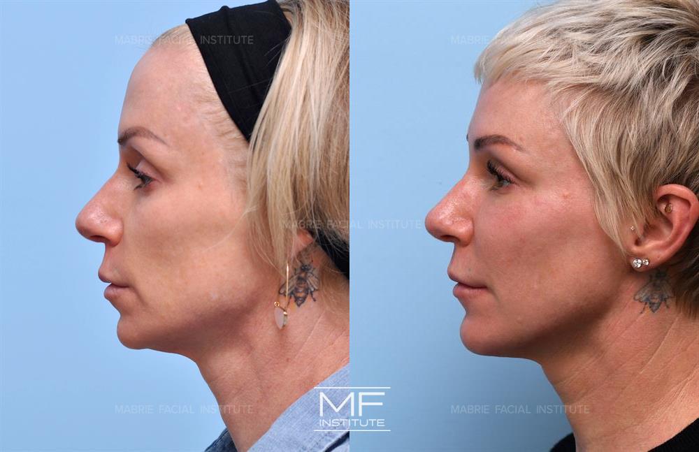 Before and after jawline filler to snatch your face case #705