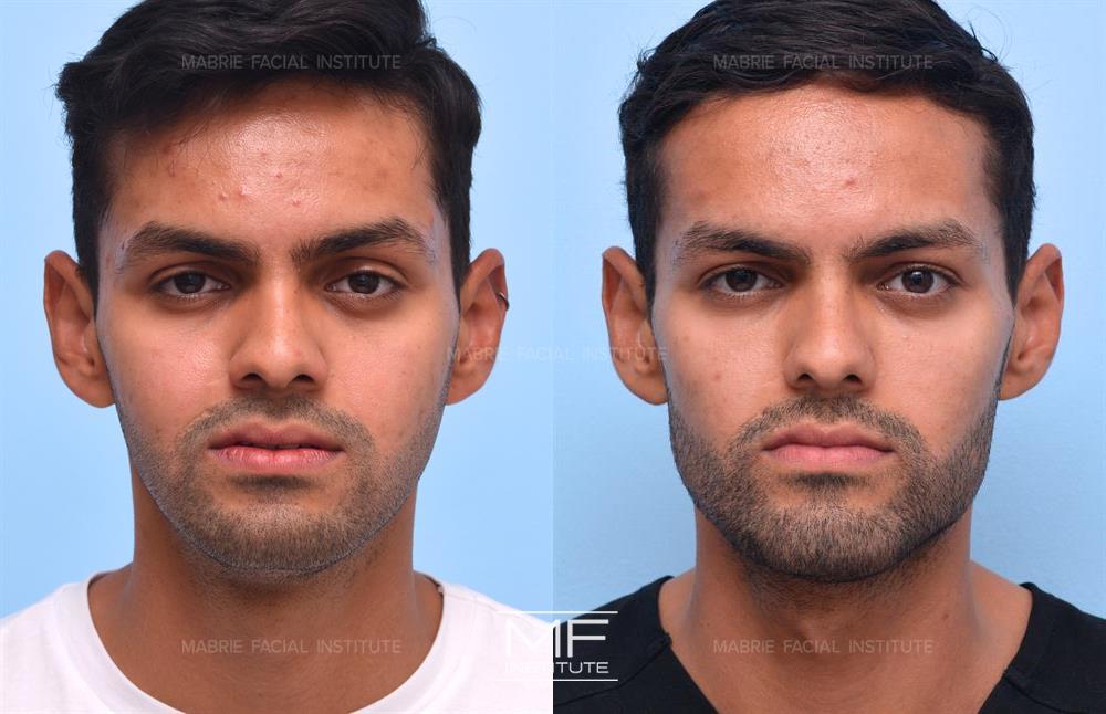 Before and after chin filler to make the chin wider or more square case #721