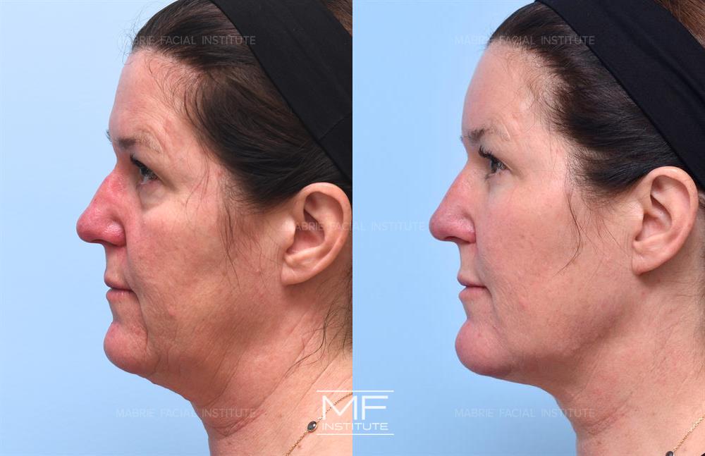 Before and after jawline filler to improve the appearance of the neck case #723