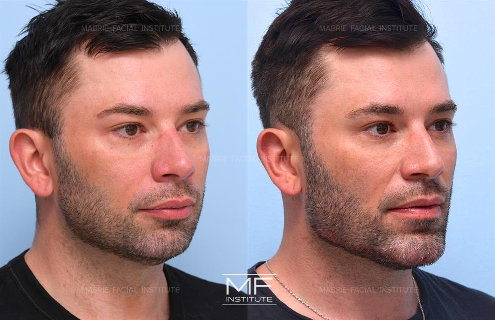 Before and after jawline filler to snatch your face case #726