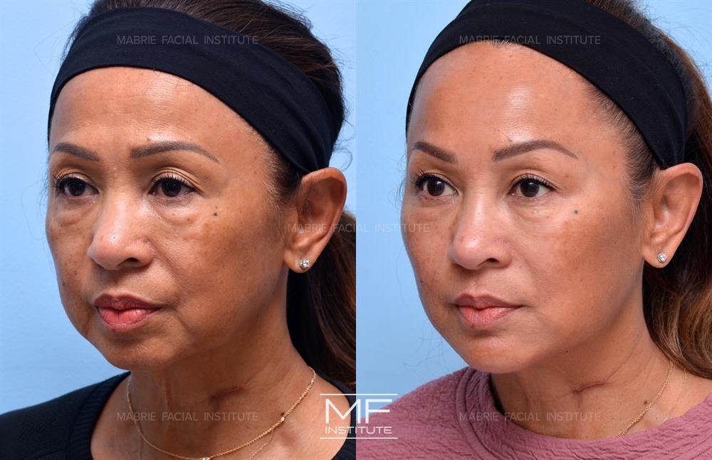 Before and after jawline filler to reduce jowling case #735